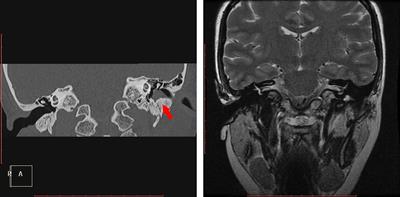 Ceruminous adenoma of the external auditory canal: 9 cases series with imaging and pathologic findings